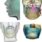 Soft-Tissue Simulation for Computational Planning of Orthognathic Surgery